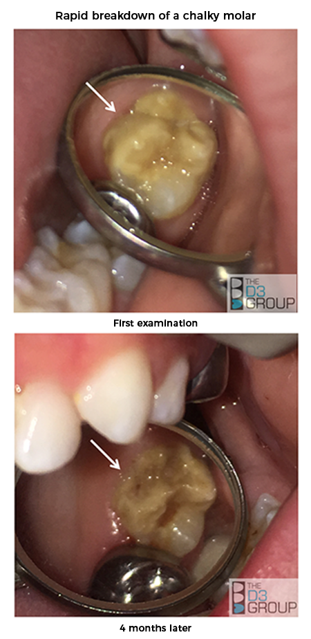 Rapid Breakdown of Chalky Molar